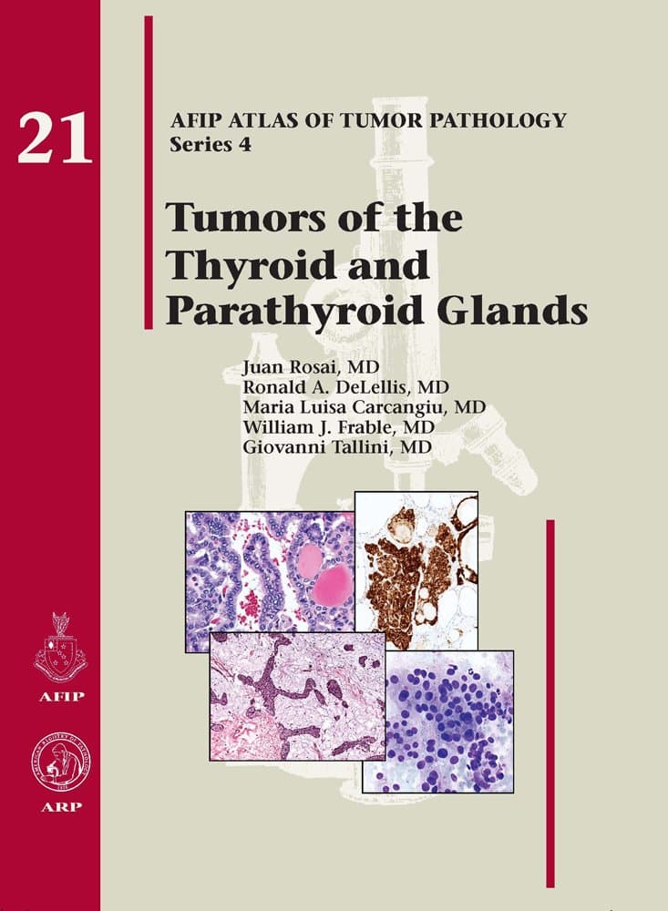 Tumors of the Thyroid Glands