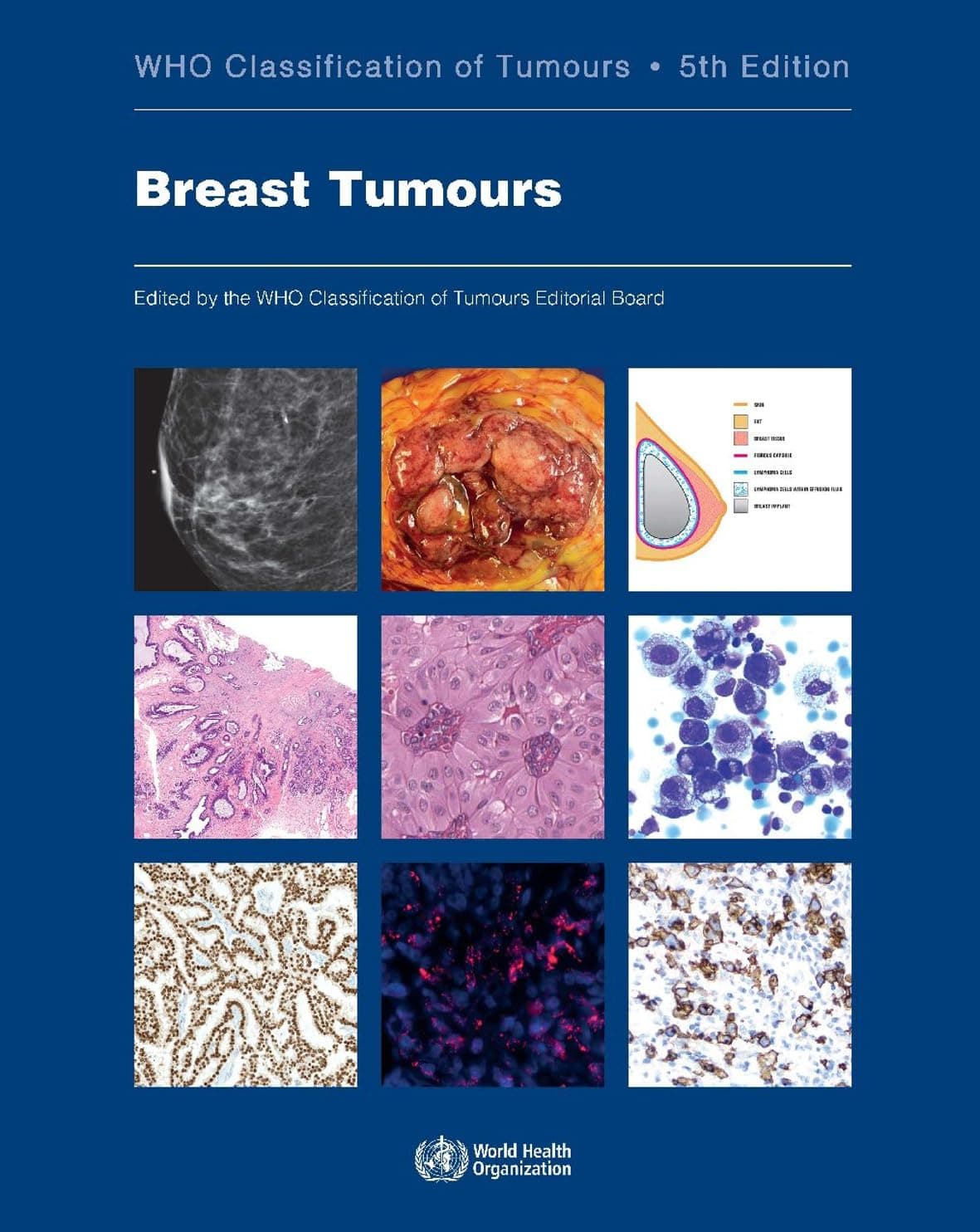 Breast Tumours: WHO Classification of Tumours (Medicine) - WHO Classification of Tumours Editorial Board